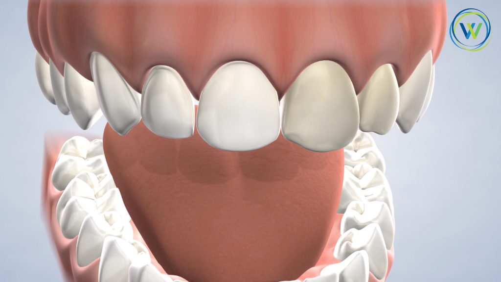 Full-Mouth Rehabilitation | Winterholler Dental Implants & Cosmetic
